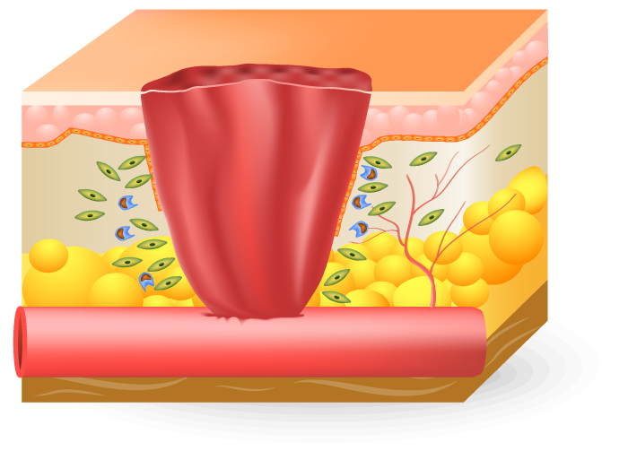 Inflammatory Phase Home Landing Page Health Factor Products 7 Inflammatory Phase of wound Home Landing Page Health Factor Products